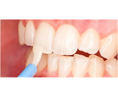 Фторирование зубов