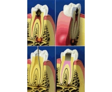 Периодонтит